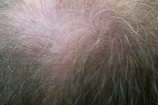 Lire la suite à propos de l’article Comment ralentir naturellement la perte de cheveux ?